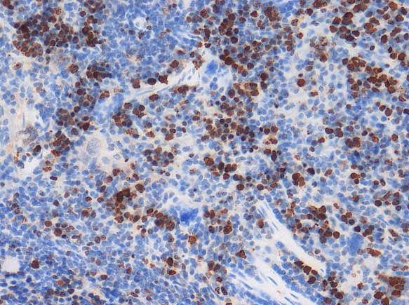 This is the IHC analysis of Ki67